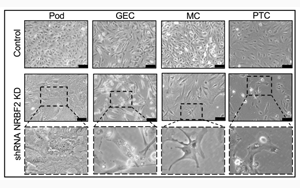 Nature子刊：糖尿病腎病的新靶點(diǎn)可預(yù)防終末期腎衰竭