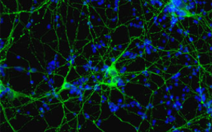 《Nature Medicine》可溶性 tau 聚集體的新發(fā)現(xiàn)