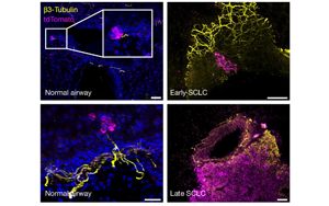 癌細(xì)胞會(huì)放電？Nature揭示小細(xì)胞肺癌擴(kuò)散新機(jī)制