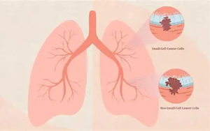 DNA甲基化與基因組改變協(xié)同驅(qū)動非小細(xì)胞肺癌演化的機制研究