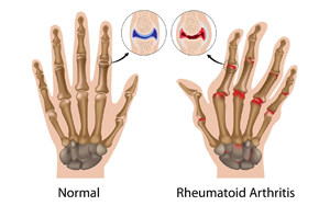 中性粒細胞與白蛋白比率（NPAR）：類風濕關(guān)節(jié)炎骨質(zhì)疏松風險的新型預(yù)測因子及其臨床轉(zhuǎn)化價值