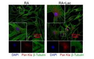 組蛋白乳酸化修飾通過上調(diào)NFATc2表達及抗乳酸化組蛋白自身抗體促進類風濕關節(jié)炎進展