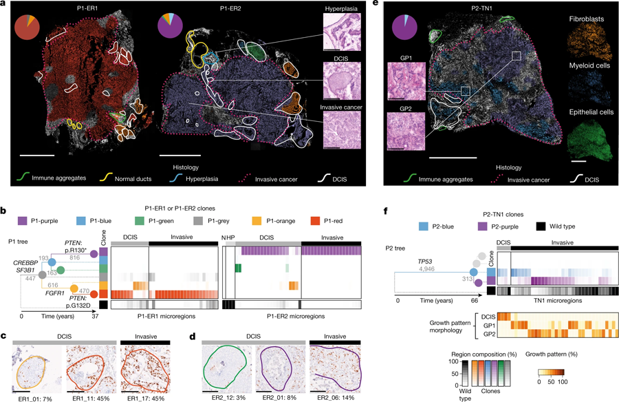 由三位原發(fā)性乳腺癌患者的組織學(xué)檢測繪制的遺傳克隆圖