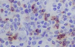 早期預(yù)測(cè)CAR-T細(xì)胞治療反應(yīng)的新生物標(biāo)志物