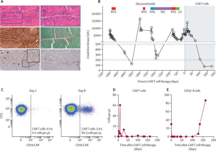 CAR T細(xì)胞對抗突觸綜合征表現(xiàn)的影響
