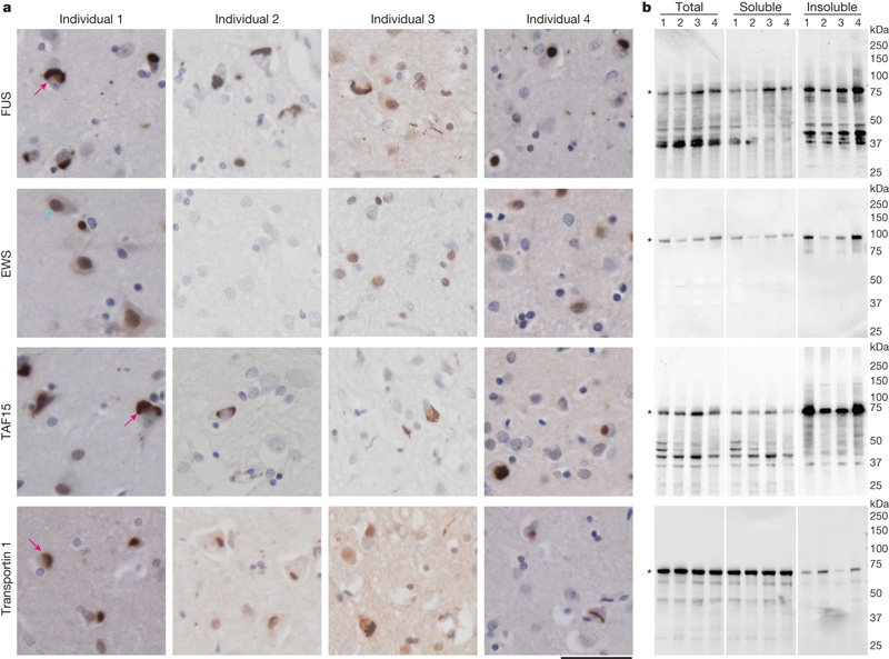 額顳葉退化蛋白包含F(xiàn)ET蛋白和遠(yuǎn)轉(zhuǎn)蛋白1