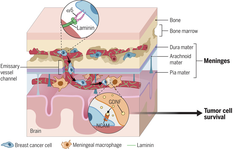 乳腺癌細胞轉(zhuǎn)移和在腦脊膜的促生交互